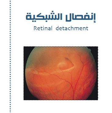 إنفصال الشبكية (Retinal detachment)