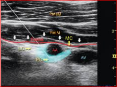تم نشر مقالة علمية للتدريسي في قسم تقنيات التخدير المدرس المساعد محمد عبد الزهرة صعصاع بعنوان Ultrasound-guided brachial plexus blocks in pediatric anesthesia