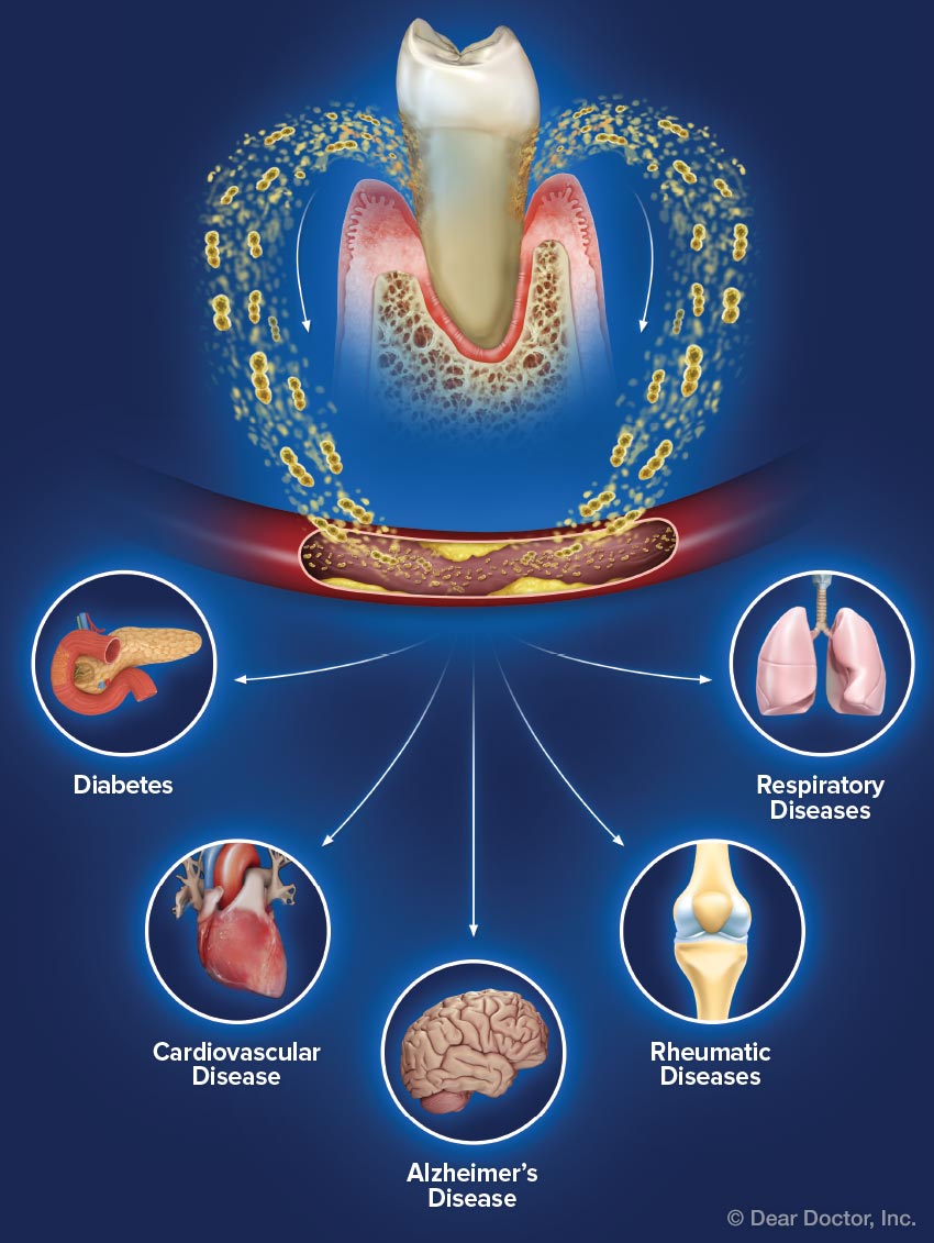 مقالة علمية للدكتور محمد فارس جعباز بعنوان ( Oral Inflammation and Respiratory  Diseases )
