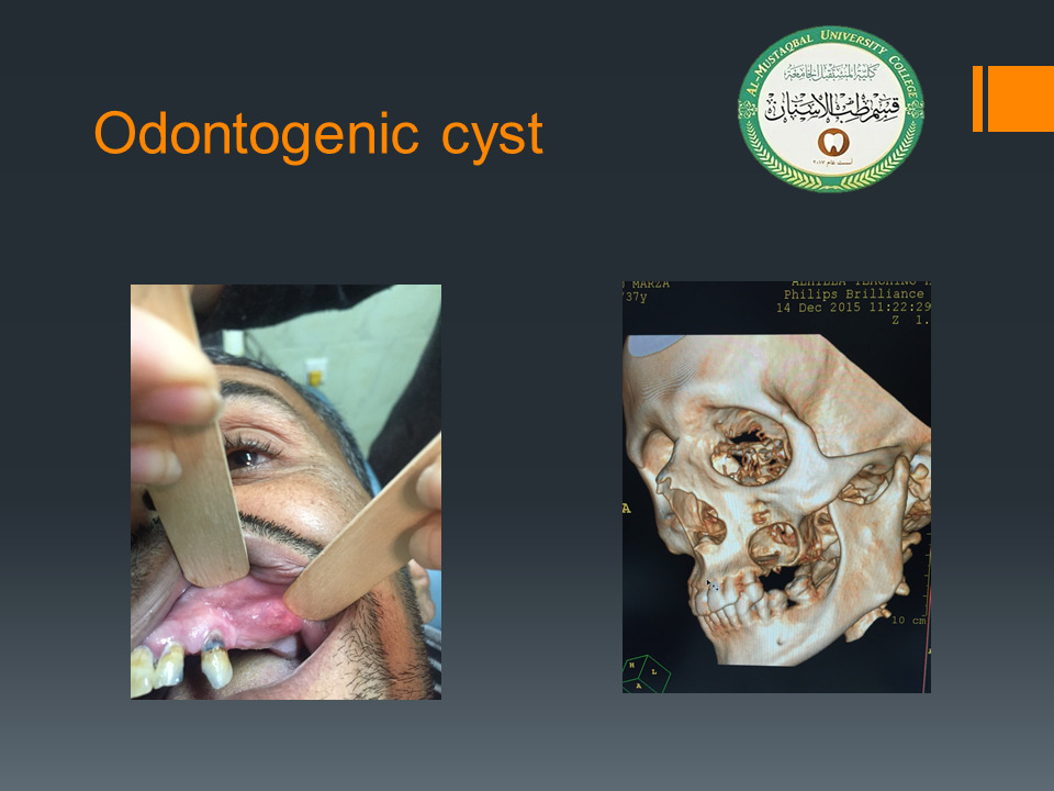 قسم طب الأسنان يقيم ندوه علميه ألكترونيه بعنوان (Odontogenic cyst)