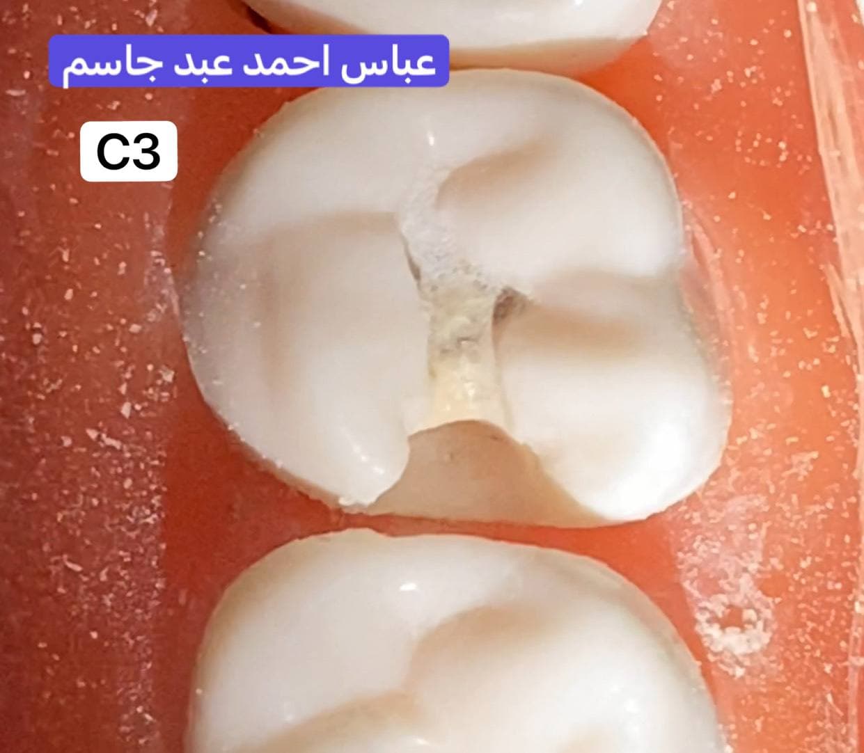 قسم طب الأسنان يجري مسابقة لطلبة المرحله الثالثه  في مادة معالجة الأسنان
