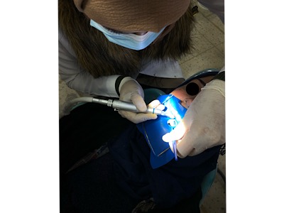 Direct anterior composite restoration