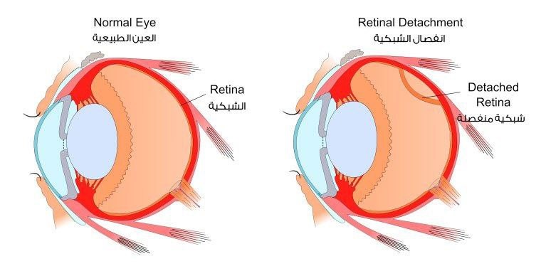 مقالة علمية للمعيدة زينب احمد عباس بعنوان (انفصال الشبكية (Retinal Detachment))