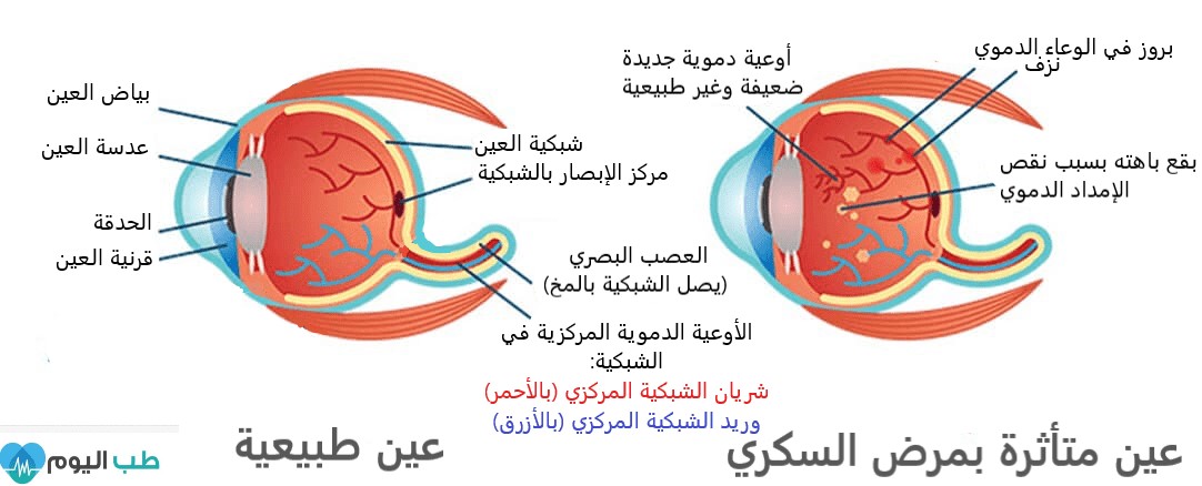 ورشة تعليمية عن (تأثير السكري على الأوعية الدموية واعتلال شبكه العين)