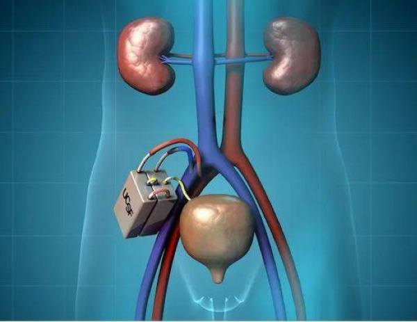 Artificial kidneys. a revolution in the world of medicine