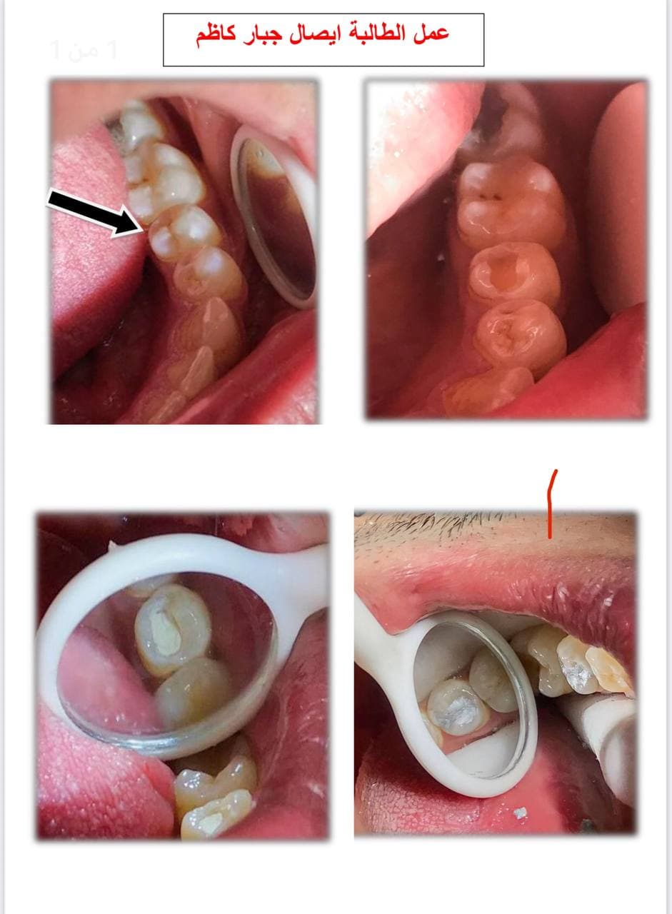Part of the creativity of the student Issal Jabbar Kadhim in making a light filling for a patient