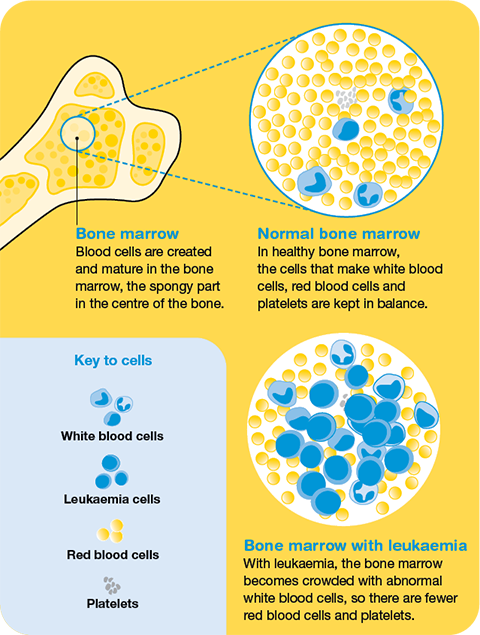 الدكتورة اثمار رضاLeukaemia 