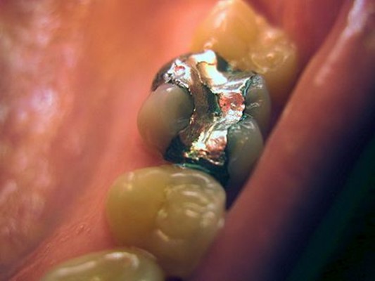 How are dental amalgams made