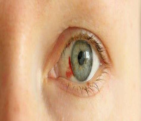 Hemorrhagic Fevers