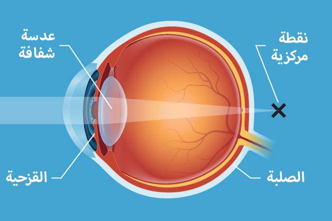 مقالة علمية للتدريسي مهيمن سمير عارف بعنوان (Hypermetropia )