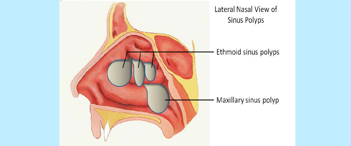 مقالة علمية للدكتور علي النصراوي بعنوان (Antrochoanal Polyps)