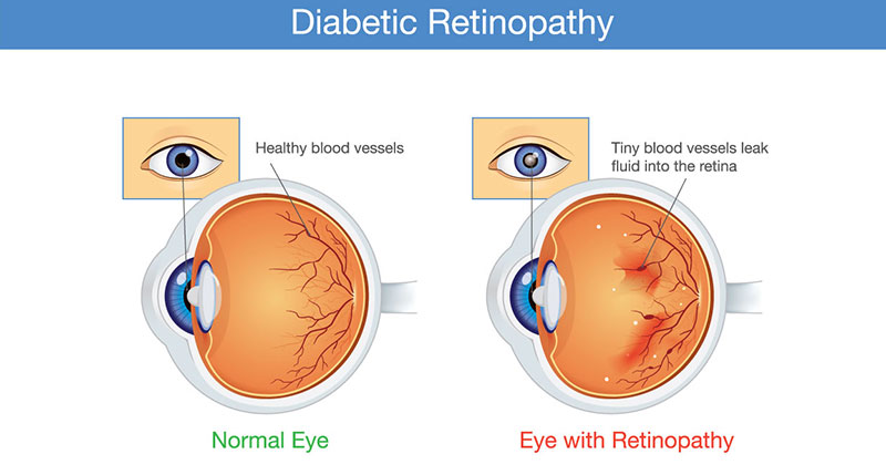 مقالة علمية للدكتوره لينوفر علي حمود بعنوان (Effect of uncontrolled diabetes on the lens of the eye)