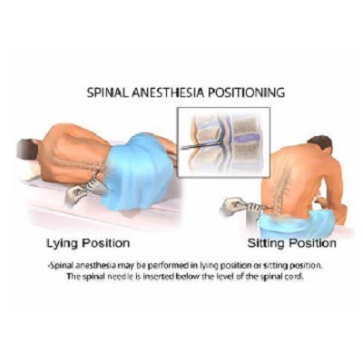 Illuminating the Depths: A Comprehensive Exploration of Spinal Anesthesia