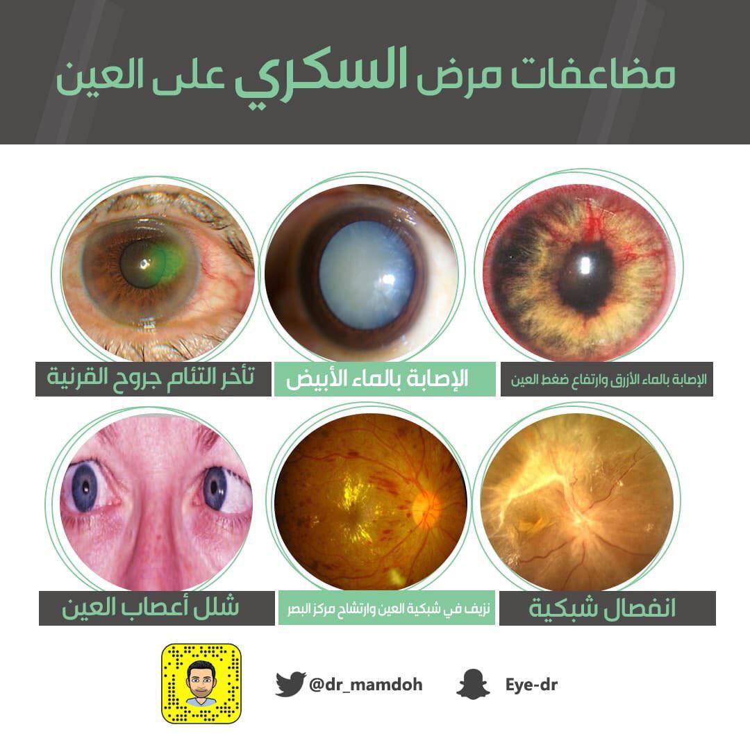 مقالة للمعيدة تمارا نهاد عباس بعنوان (تأثير مرض السكري على العين اعتلال الشبكية السكري)