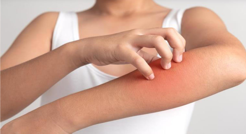 مقالة علمية ل( هبه صلاح هادي) بعنوان"" الاطعمة الي تسبب الحساسية""