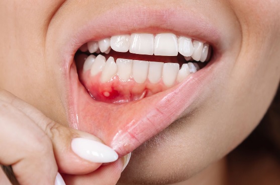 " Symptoms and causes canser mouth "  by ghadeer talib 