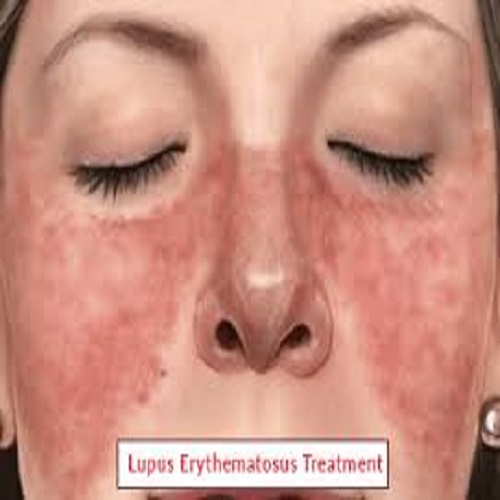 Systemic lupus erythematosus (SLE) 