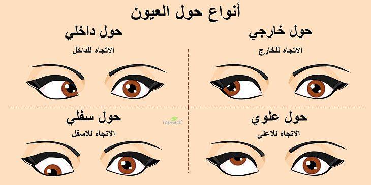 مقالة علمية بعنوان علاج الحول بالليزر للمعيدة سارة عباس مسلم 