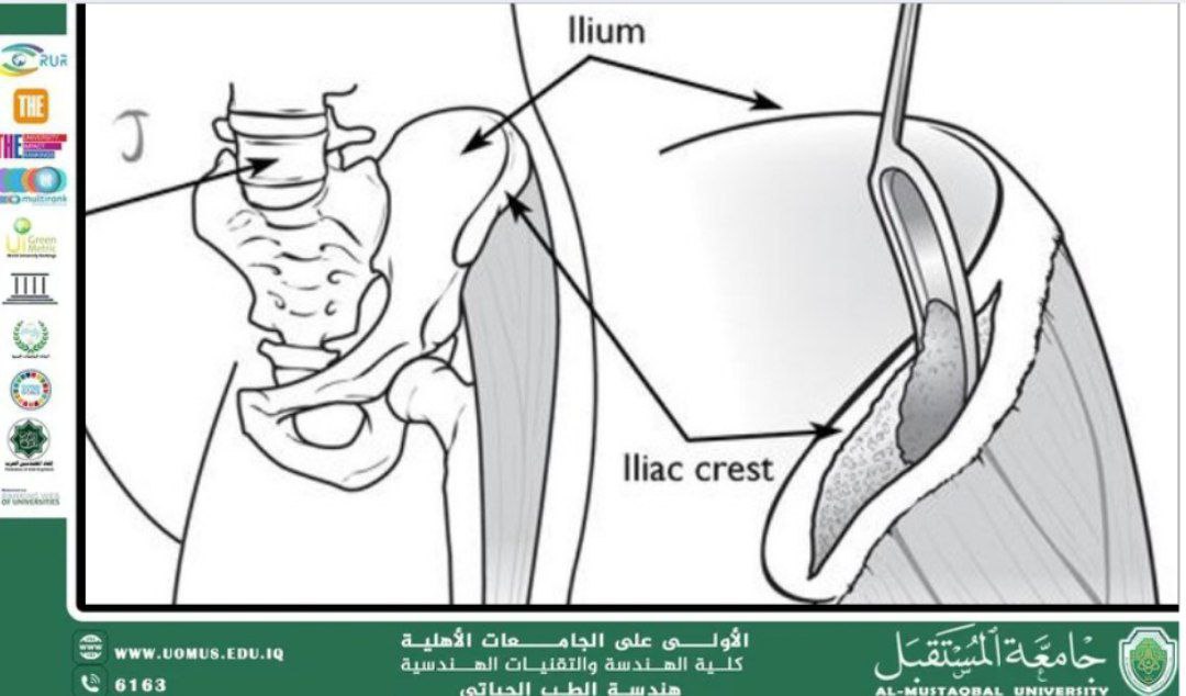 What are bone implants?