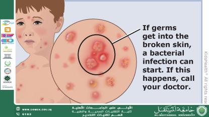 Chickenpox