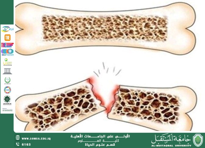 مقالة علمية للتدريسية (م.م زينب ناظم عزيز) بعنوان "هشاشة العظام: الأسباب، الأعراض، وطرق الوقاية "