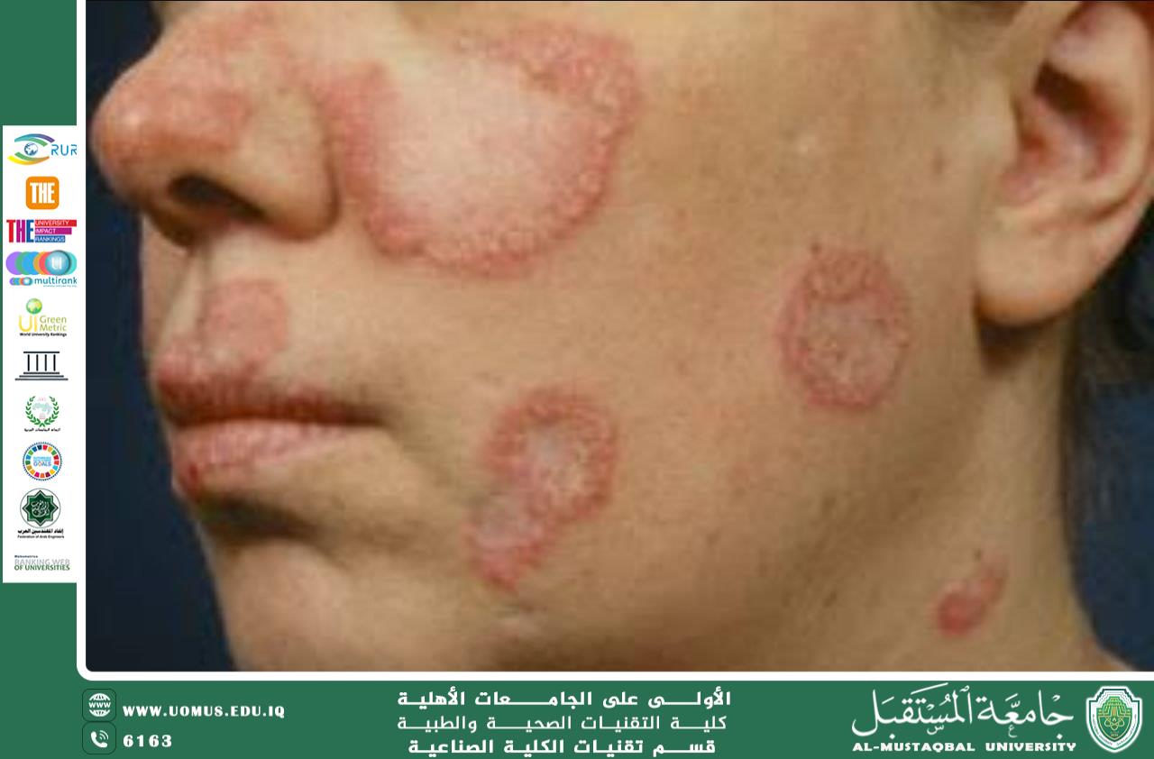 Renal Involvement in Systemic Lupus Erythematosus
