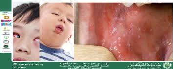 Measles