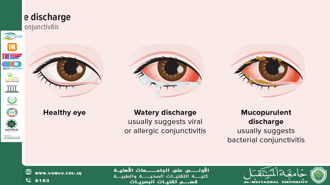 مقالة علمية للدكتور غيث علي محمود بعنوان (الفرق بين الموكسيفلوكساسين والسيبروفلوكساسين في علاج التهابات الملتحمة).