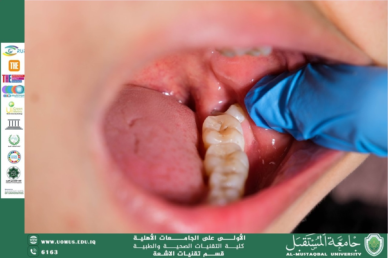 An article entitled "Wisdom Tooth Infection" by Ghadeer Talib