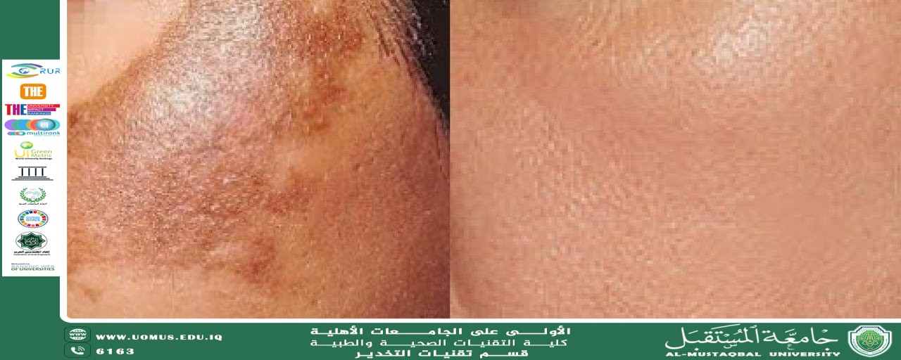 التقنيات الحديثة في إزالة التصبغات الجلدية بالليزر: أنواعها وفعاليتها