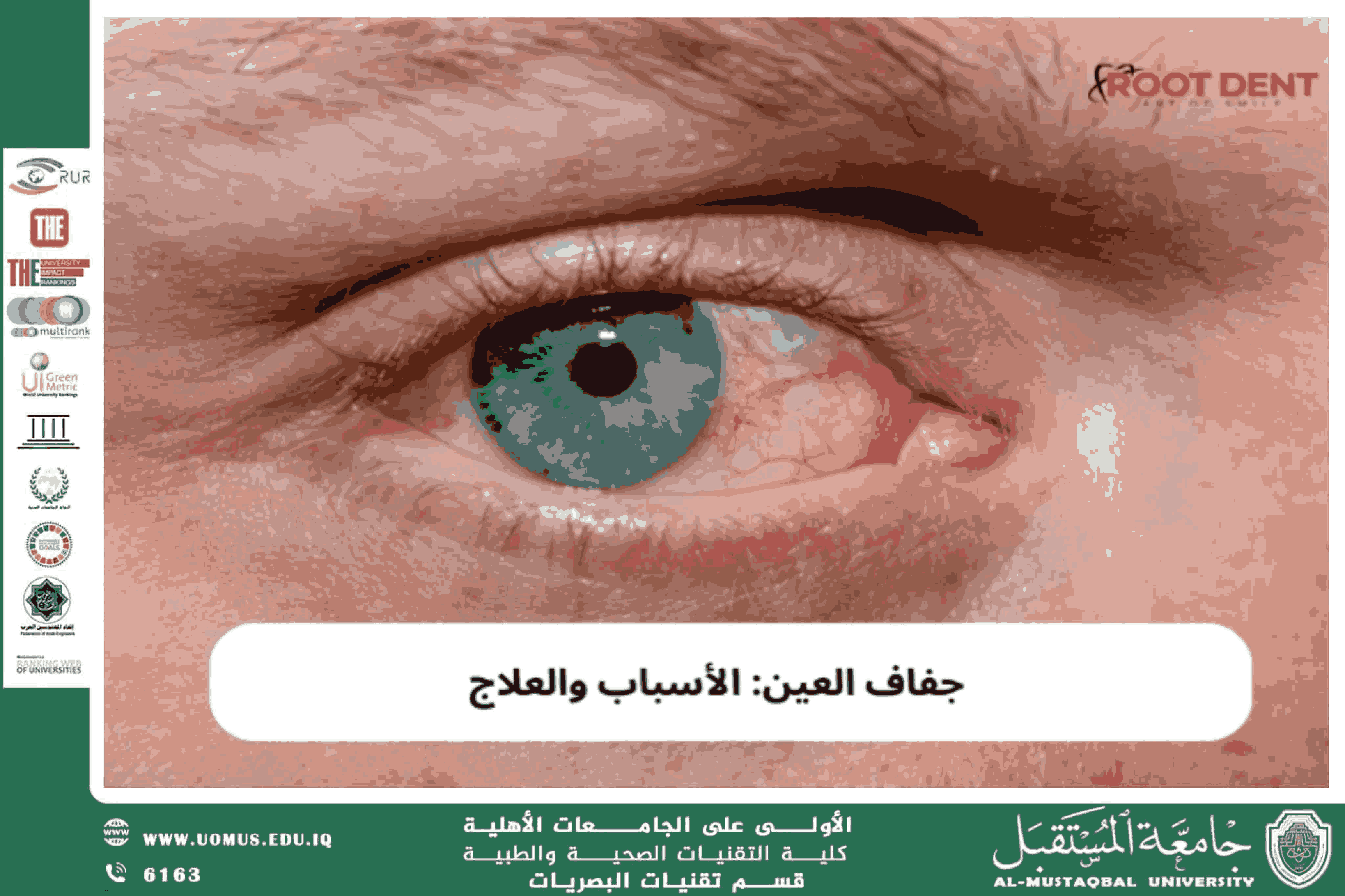مقالة علمية للتدريسي أ.م.د منذر سمين شكر (اسباب جفاف العين )