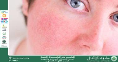 مقالة للاستاذ علي رسول حول الحساسية لدى الشباب عند سن البلوغ: الأسباب والتغيرات المناعية في مرحلة التحول الهرموني