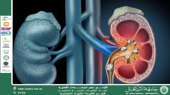  Kidney Stones: Causes, Symptoms, and Prevention