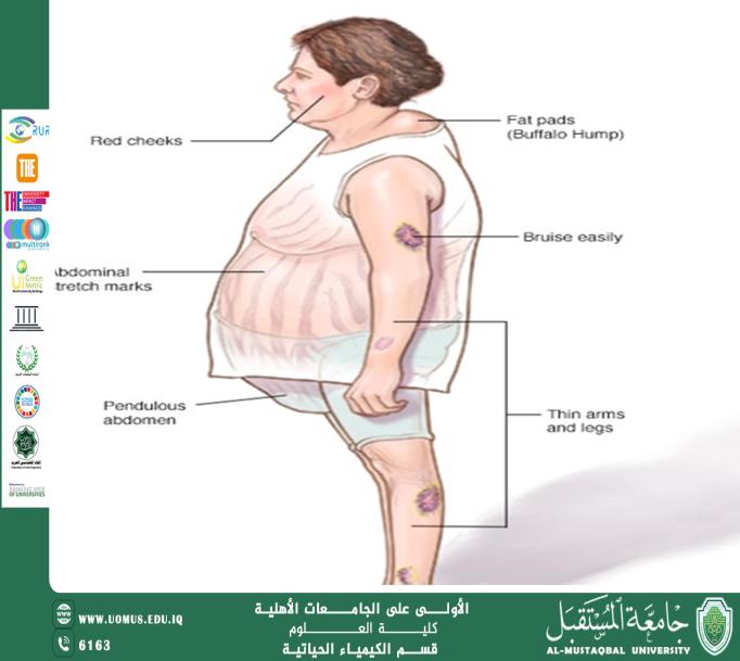 مقالة علمية للتدريسية م.د.داليا شاكر عبيده بعنوان متلازمة كوشينغ: تحدٍ صحي عالمي يستدعي الابتكار والوعي لتحقيق أهداف التنمية المستدامة"