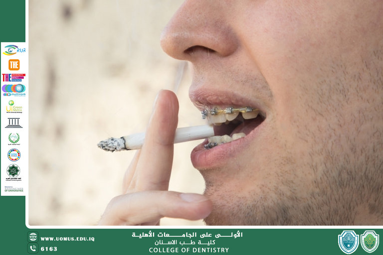 تأثير التدخين على علاج تقويم الأسنان الثابت